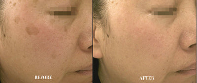 Mode Aesthetics GlowOn Laser Skin Rejuvenation Device