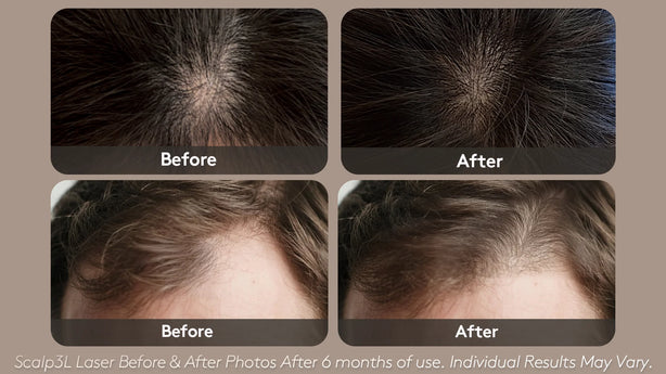 Breo - Scalp 3L Hair Growth Laser Massager